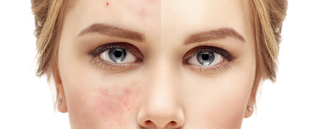 Minimize the Visibility of Your Acne Scars with CO2 Resurfacing