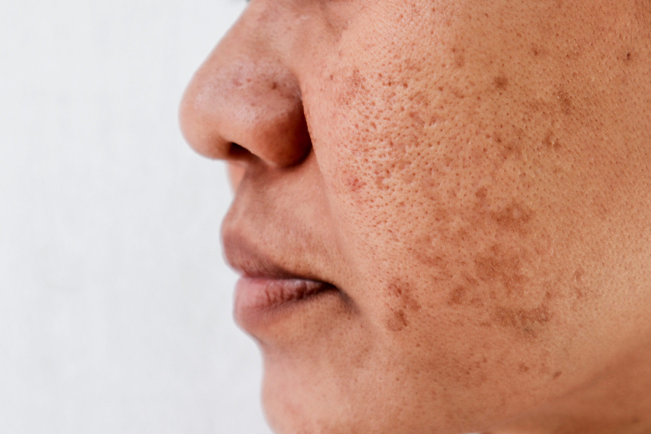 How to Keep Your Melasma Under Control￼